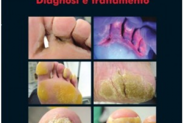 Le infezioni fungine del piede